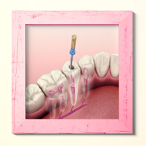 عصبکشی دندان