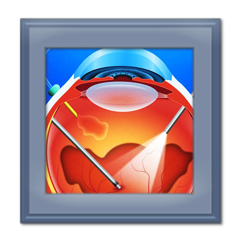 ویترکتومی چیست و چگونه بینایی را بهبود می بخشد؟