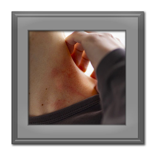 علت عرق سوز شدن؛ پیشگیری و ۱۲ روش درمان خانگی آن